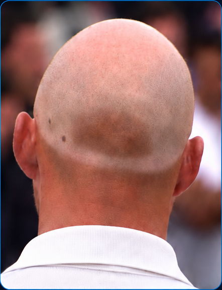Visible hat hole tan line on a bald scalp
